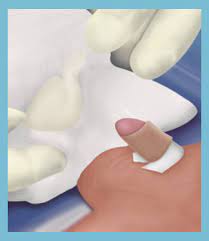 The incision starts off red and tender. Post Circumcision Infant Care Pollock Clinics Vancouver Bc
