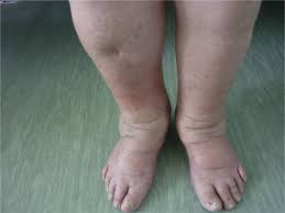 Image result for Localized Edema