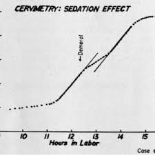 Image result for Labor Sedation