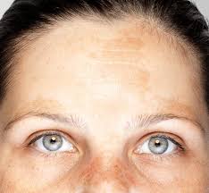 Image result for Melasma