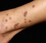Patients with skin disease show response to targeted ...