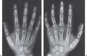 (a) distal phalanx 1st digit, (b) interphalangeal joint, (c) proximal phalanx 1st digit. Fractures And Dislocations Of The Hand And Carpal Bones In Children Musculoskeletal Key