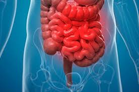 Image result for Proctitis