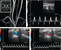 Sss is an insufficiency cerebrovascular system. Neuroimaging In Subclavian Steal Syndrome Bmj Case Reports