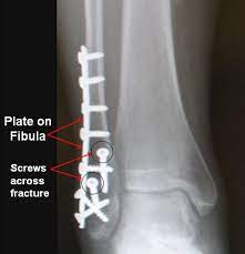 Ankle Fracture Surgery Footeducation Ankle Fracture Broken Ankle Ankle Surgery