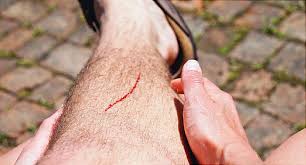 Someone is stabbing the delicate area of your inner elbow [or if you are unlucky, the as such, blood tests don't hurt. Pictures Of The Wound Healing Process