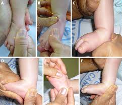 Club foot can affect 1 or both feet. Functional Physiotherapy Method Results For The Treatment Of Idiopathic Clubfoot