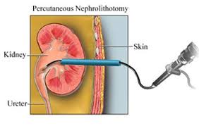 India Surgery Percutaneous Nephrolithotomy Cost Nephrolithotomy Mumbai Percutaneous Nephrolithotomy Surgery Surgery Prostate Surgery Medical Treatment