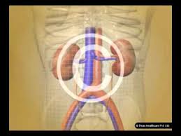 Kidney Stone Hindi Youtube