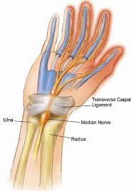 Carpal Tunnel Syndrome