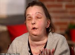 First American to have second face transplant shows off new face