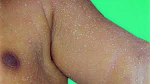 Image result for sweat rash on back baby