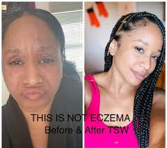 Lea Vasquez shares her Topical Steroid Withdrawal experience : u/Lea_Vasquez