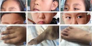 Fraternal Twins With Phelan Mcdermid Syndrome Not Involving The Shank3 Gene Case Report And Literature Review Bmc Medical Genomics Full Text