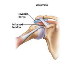 Bony growths that rub against and irritate the bursa and tendons. Shoulder Bursitis Physio Works
