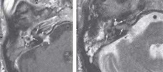 Image result for Bacterial Labyrinthitis