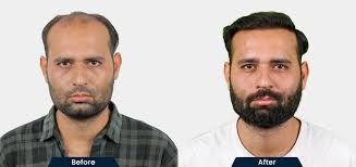 Effective Hair Transplant in Mumbai: Expert Surgeons, Advanced Techniques
