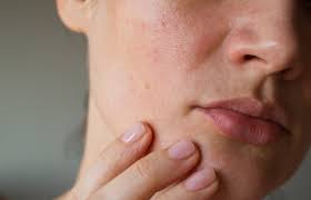 Manchas en la Cara: Tipos, Causas y Tratamientos | Skin-C Mag