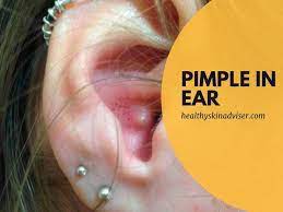 This Your Preferred Guide On How To Get Rid Of A Pimple In Ear Learn The Basics Of Pimple In Ear And How To Pop A Pimple In Ear Pimple Painful