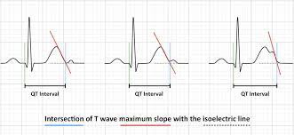 Qt Interval Litfl Ecg Library Basics
