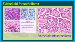 Treatment for epithelial mesothelioma can vary depending on the subtype and stage of the cancer. Epithelioid Mesothelioma Asbestos Mesothelioma Attorney 6 Youtube