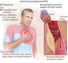 A assistência médica é essencial, já que, quanto menos tempo passar, maior a possibilidade de recuperação. Natal E Ano Novo Correlacao De Incidencia Do Infarto Agudo Do Miocardio Brazilian Journal Of Cardiovascular Surgery Blog
