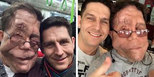 No One Believes We're Identical Twins”. The Disease Affected Adam Pearson  Differently Than His Brother, but He Became an actor
