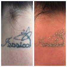 This Is A Clients Before And After Of Their First Session The Photo Was Taken Immediately After Notice The Redness And The Tattoos Tattoo Cream Laser Tattoo
