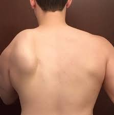 Image result for Winged Scapula