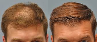 Hair loss, therefore, tends to persist in thyroid patients, notwithstanding appropriate management and treatment. Q And A For Hair Loss Alopecia And Hair Transplants Bluffton Sun