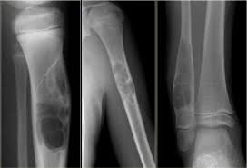 A bone tumor specialist will likely order a bone scan, ct scan, mri scan or biopsy. The Radiology Assistant Bone Tumor Differential Diagnosis And Systematic Approach Tumor Diagnosis Malignant Tumor
