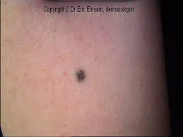 Image result for Blue Nevus