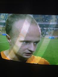 Just shave it off lad, no shame in it! #smashinghairline
