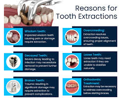 Image result for Tooth Extraction