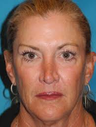 CO2 Laser Resurfacing Before and After Photos