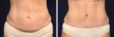 Belly Button Before After Photos