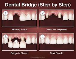 The bridge (or fixed partial denture, as it is sometimes called) is supported by your natural teeth. Dental Bridges Dr Curtis Kaiser College Station Tx