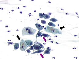 Edited by frappart l, fontaniere b, lucas e, sankaranarayanan r. Cytopathology Of The Uterine Cervix Digital Atlas