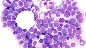 Image result for Acute Leukemia