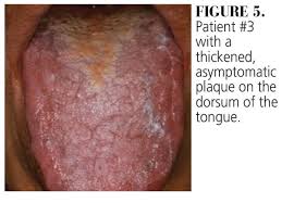 Image result for lichen planus on tongue)
