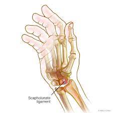 Wrist Sprains - Overview - Mayo Clinic Orthopedics & Sports Medicine