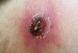 Two red fang marks may be visible, and surrounding redness may appear within one hour of the bite. Picture Of Brown Recluse Spider Bites Picture Image On Emedicinehealth Com