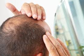 Gradual thinning of the hair on your head. Best Hair Loss Medications Hair Restoration Medical Therapy