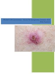 Since the first description of the merkel cell carcinoma by cyril toker in 1972, the number of studies has significantly increased over the last 4 decades. Merkel Cell Carcinoma Know Its Symptoms Causes And Risk Factors By Vivek Choudhary Issuu