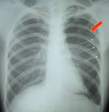 Image result for Pneumothorax