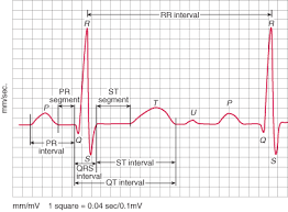 Qt Interval Qtc Prolonged Qtc Is 450 For Men 470