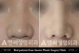 The nose may look red, swollen, and distorted. Blunt Or Bulbous Tip Correction Answer Plastic Surgery