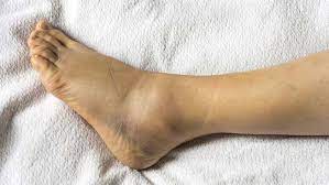A sprained ankle is one of the most common physical problems known. How To Heal A Grade 3 Ankle Sprain Fully Fast