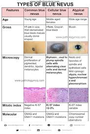 Image result for Blue Nevus