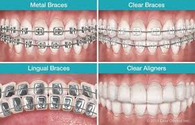 Dentaltown Orthodontics Can Be Done In Many Different Ways To Help Correct Your Particular Problem Traditional Types Of Braces Dental Braces Ceramic Braces